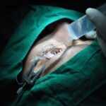 Sancti Spíritus Ophthalmological Center operates on eye tumors despite shortages