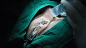 Sancti Spíritus Ophthalmological Center operates on eye tumors despite shortages