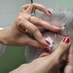 Emplean en Sancti Spíritus agujas contra la hipertensión arterial