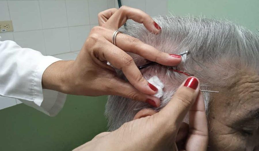 Emplean en Sancti Spíritus agujas contra la hipertensión arterial