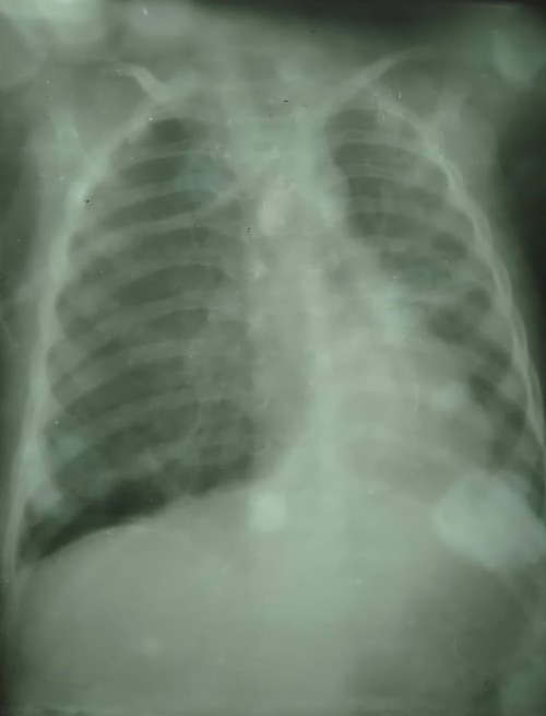 Desde la primera radiografía el panorama se presagiaba sombrío para el niño. Foto cortesía del pediátrico espirituano.