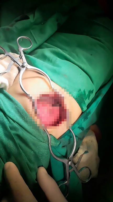 Las tres intervenciones quirúrgicas a las que fue sometido Jorgito fueron en extremo complejas. Foto cortesía del Hospital Pediátrico de Sancti Spíritus.