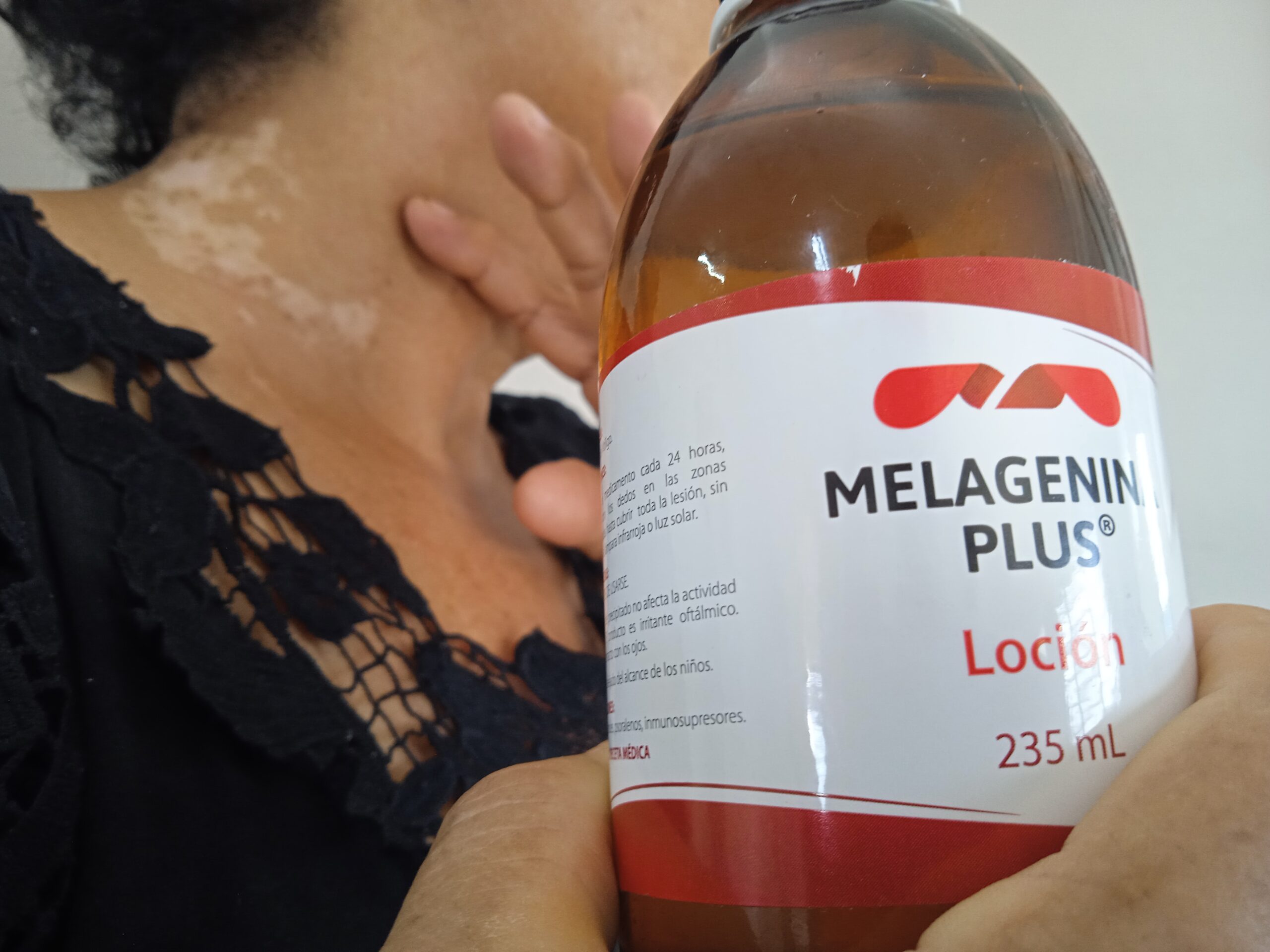 Sancti Spíritus: Otras batallas de la Melagenina Plus contra el vitiligo