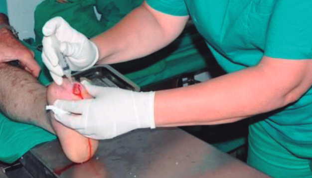 Extenderán uso del HEBERPROT-P a pacientes diabéticos de comunidades aisladas en Sancti Spíritus