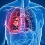 Aplican con éxito en Sancti Spíritus Programa nacional de atención integral a niños con fibrosis quística