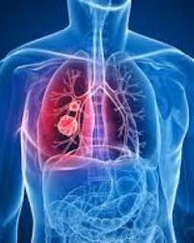 Aplican con éxito en Sancti Spíritus Programa nacional de atención integral a niños con fibrosis quística