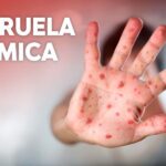 Sancti Spíritus: Viruela símica, medidas a primer plano