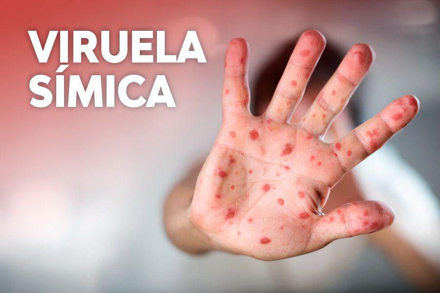 Sancti Spíritus: Viruela símica, medidas a primer plano